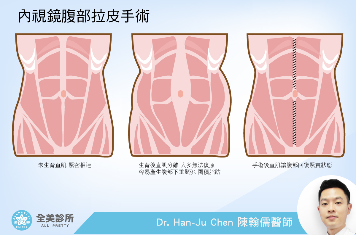 抽脂式腹部拉皮手术类型