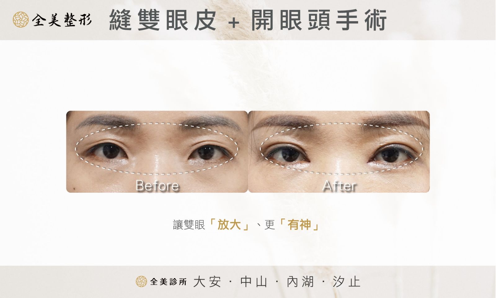 陳善艷雙眼皮+開眼頭.jpg 陳善艷雙眼皮+開眼頭.jpg