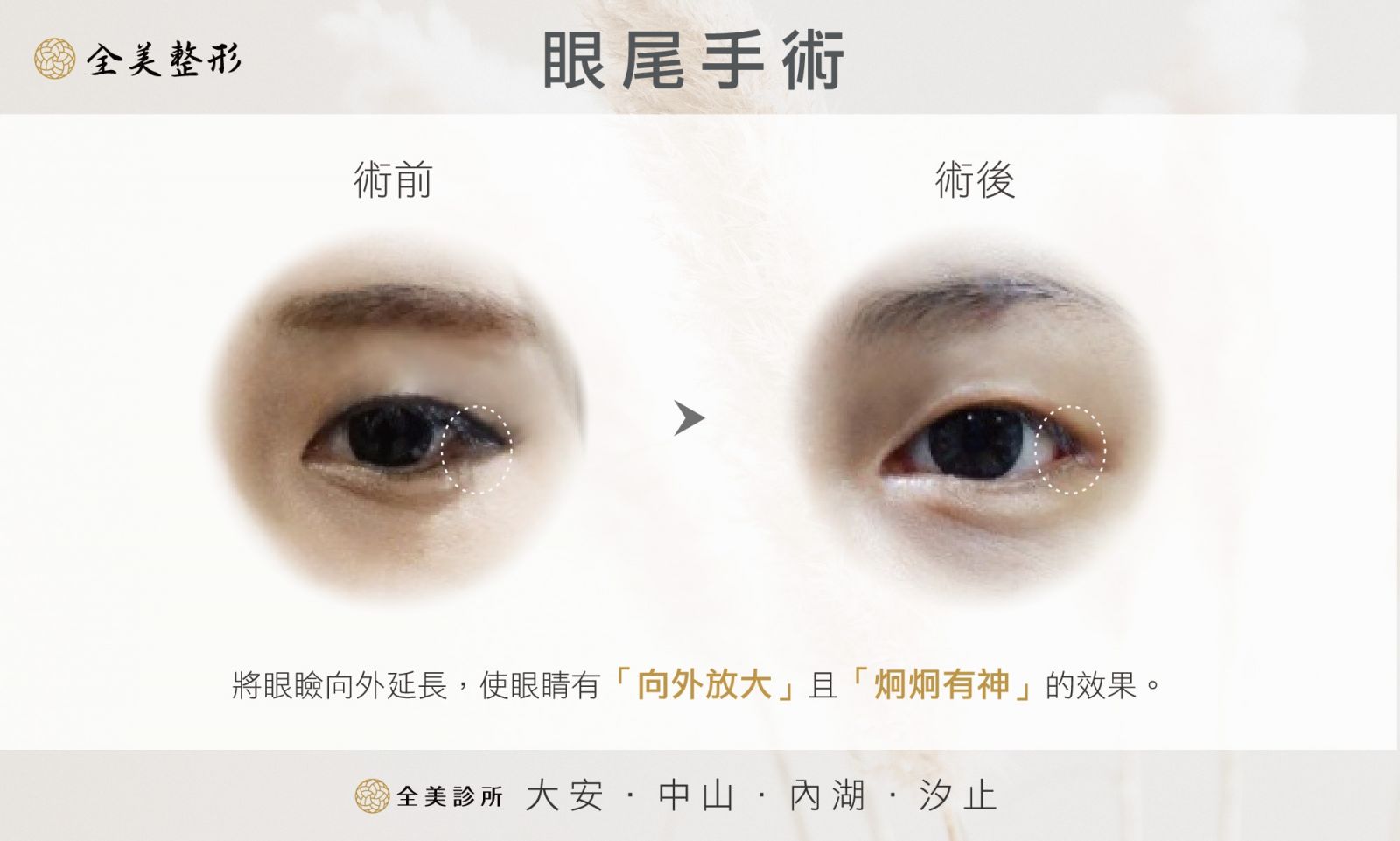 開眼尾示意圖.jpg 開眼尾示意圖.jpg